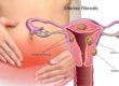 What Kind of Fibroids Affects Fertility