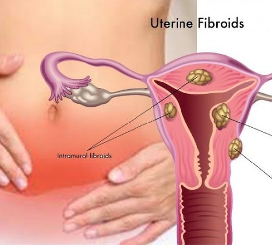 What Kind of Fibroids Affects Fertility