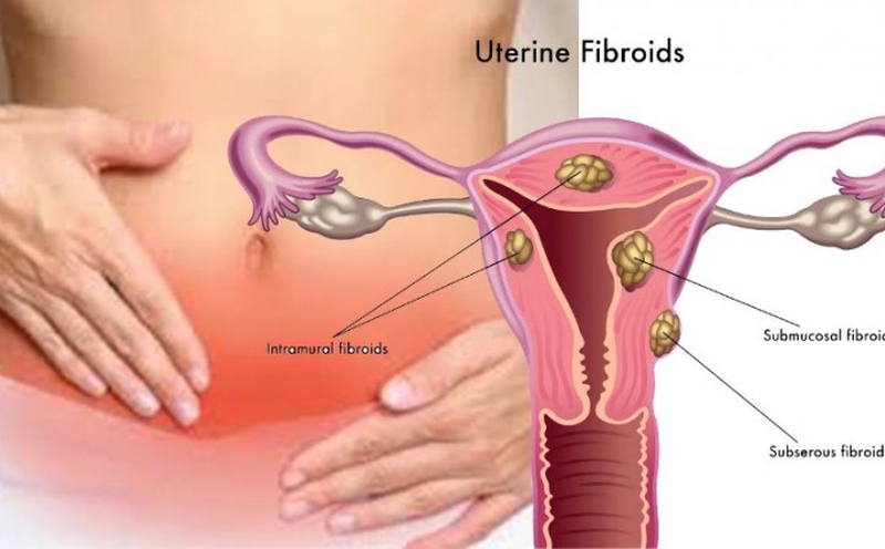What Kind of Fibroids Affects Fertility