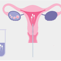 Intrauterine insemination