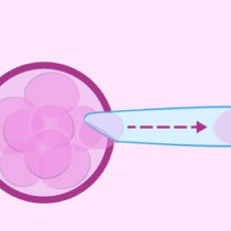 Preimplantation Genetic Diagnosis