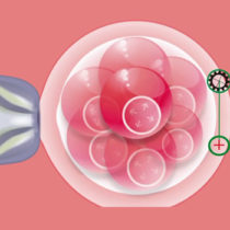 Assisted Embryo Hatching with IVF